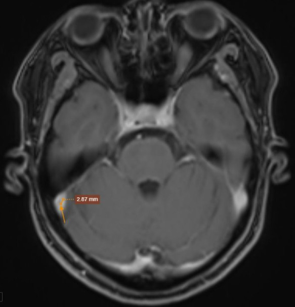 Ảnh chụp MRI não ghi nhận huyết khối tĩnh mạch sọ não. Ảnh: Bệnh viện cung cấp