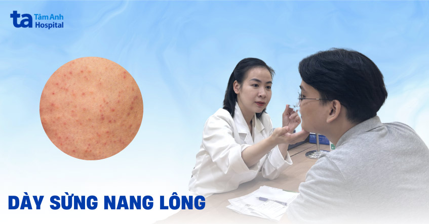 dày sừng nang lông