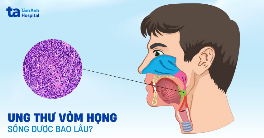 bệnh ung thư vòm họng sống được bao lâu