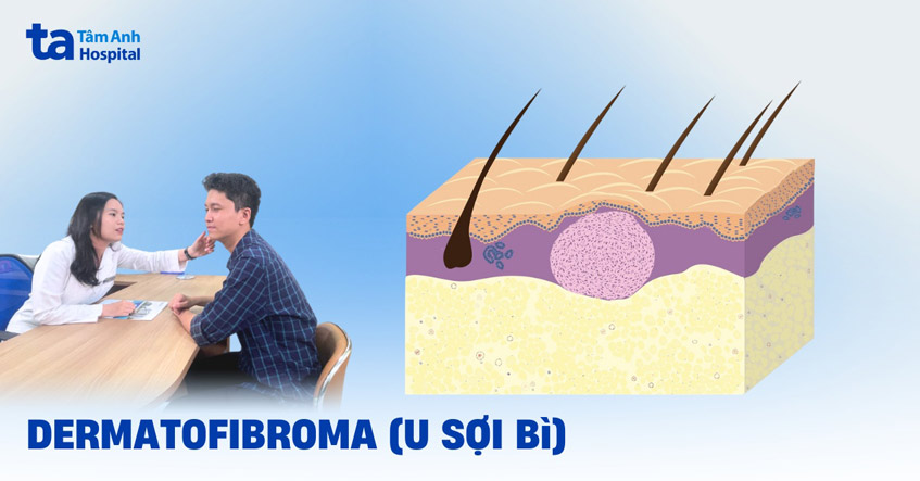 dermatofibroma
