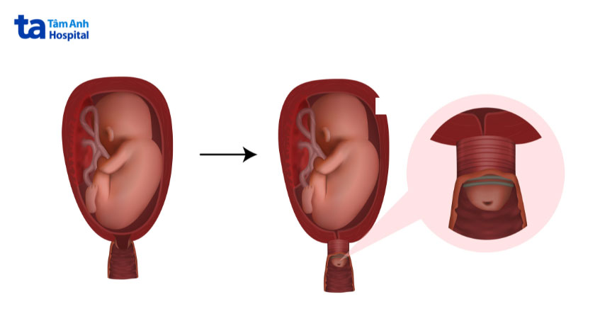 hở ở cổ tử cung