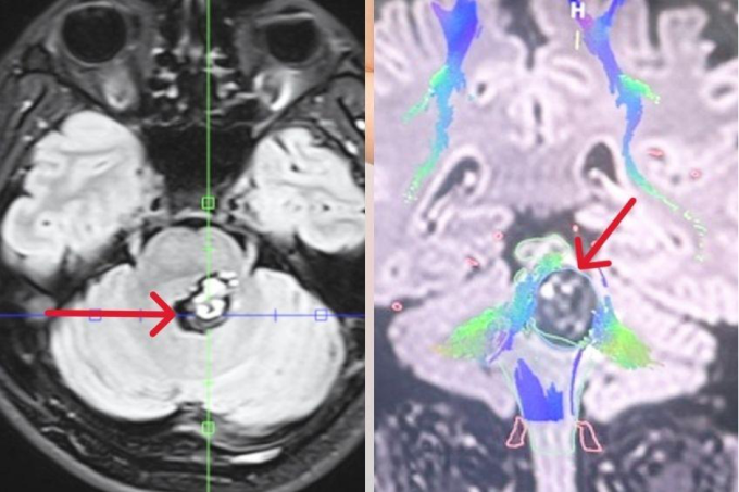 Khối u não của anh Bạch trên hình chụp MRI 3 Tesla (hình trái), bao quanh có nhiều bó sợi thần kinh (màu xanh, hình phải) trên hình chụp DTI. Ảnh: Bệnh viện Đa khoa Tâm Anh