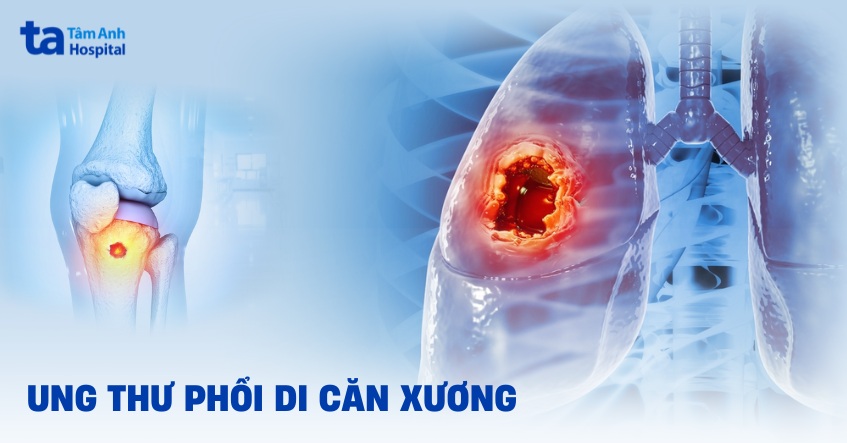 ung thư phổi di căn xương