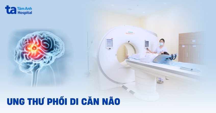 ung thư phổi di căn não