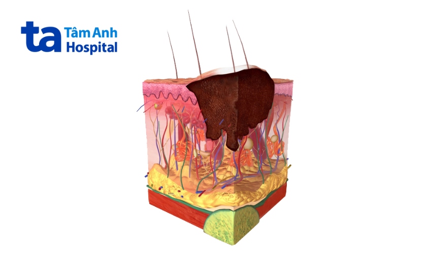 ung thư hắc tố là loại ung thư da nguy hiểm