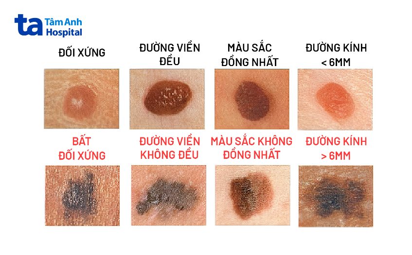 nốt ruồi bình thường và nốt ruồi ung thư hắc tố