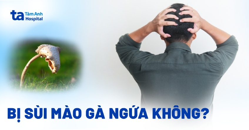 sùi mào gà có ngứa không