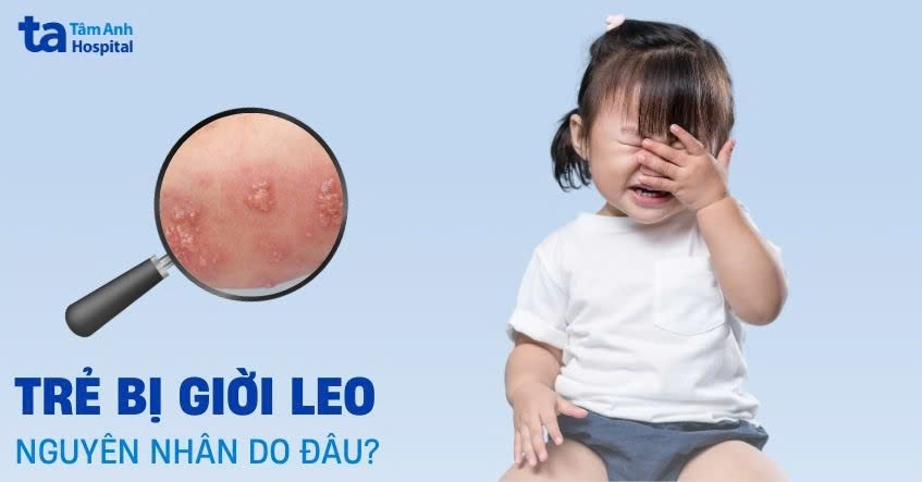 trẻ bị giời leo