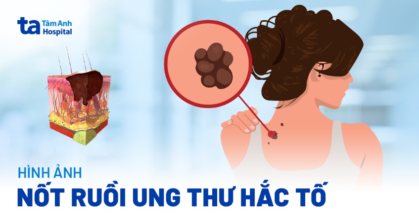 hình ảnh nốt ruồi ung thư hắc tố