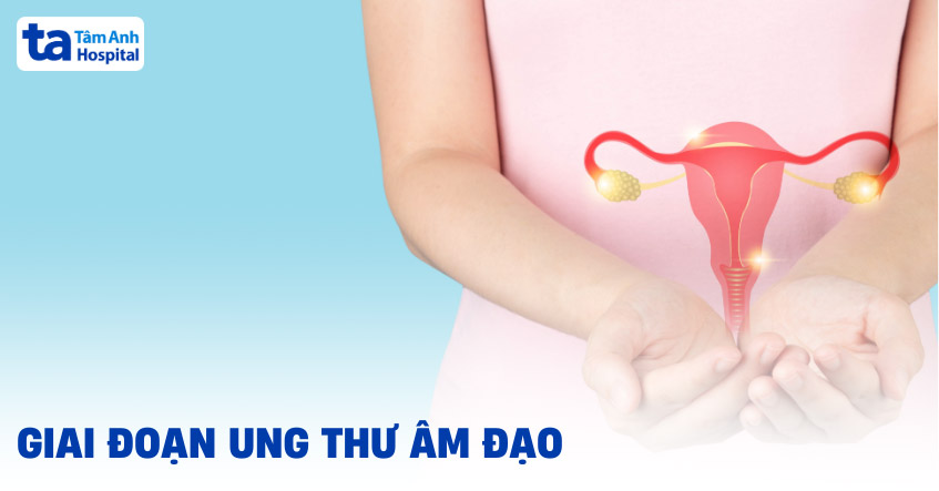 ung thư âm đạo có mấy giai đoạn