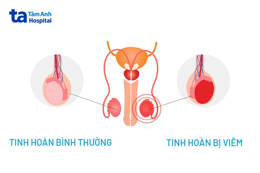 viêm tinh hoàn sau quai bị khiến tinh hoàn sưng to hơn