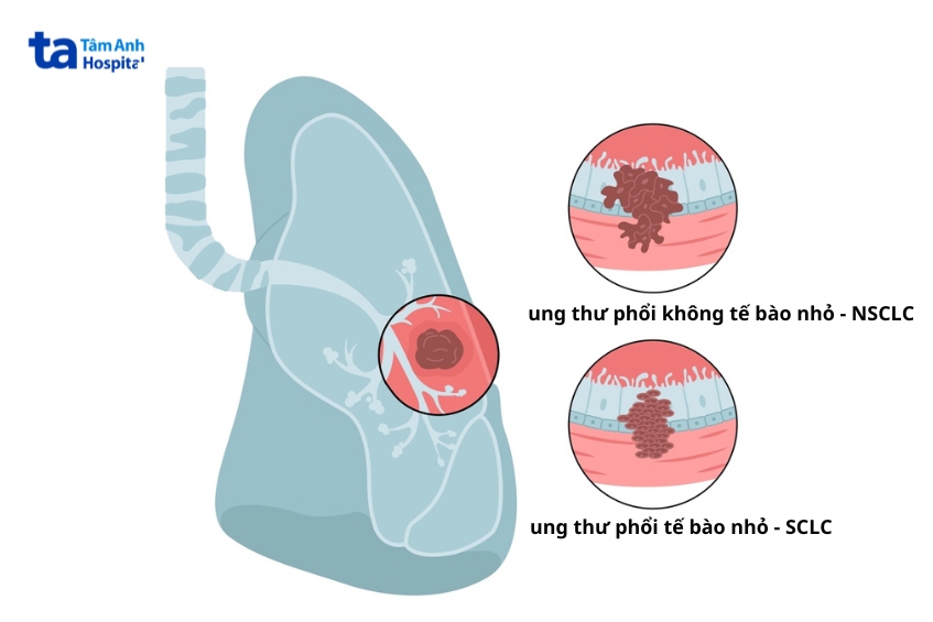 minh họa hai dạng ung thư phổi phổ biến nhất