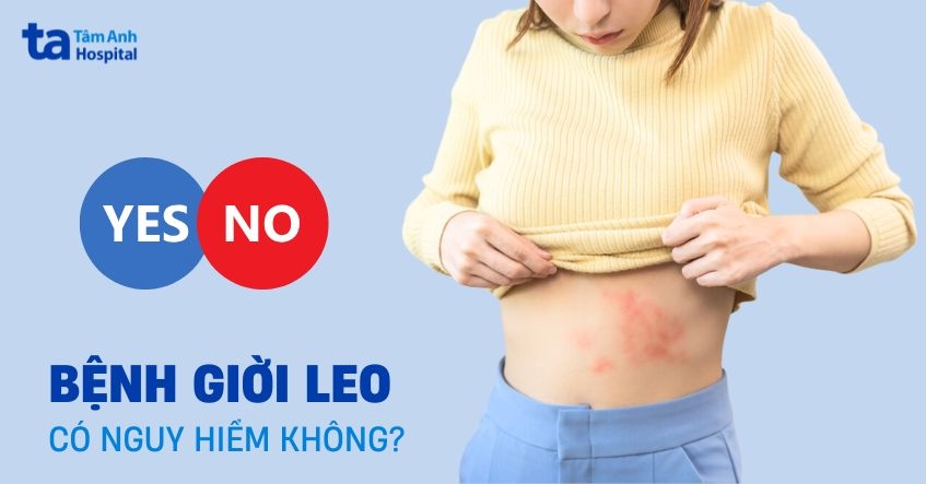 giời leo có nguy hiểm không