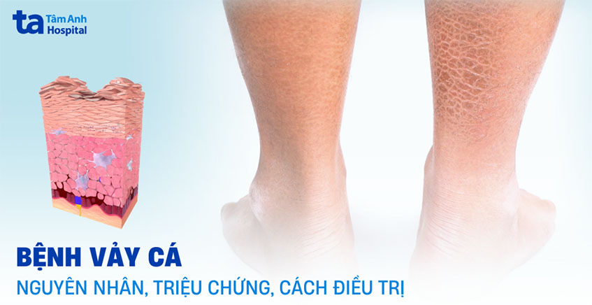 bệnh vảy cá là gì