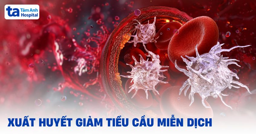 xuất huyết giảm tiểu cầu miễn dịch