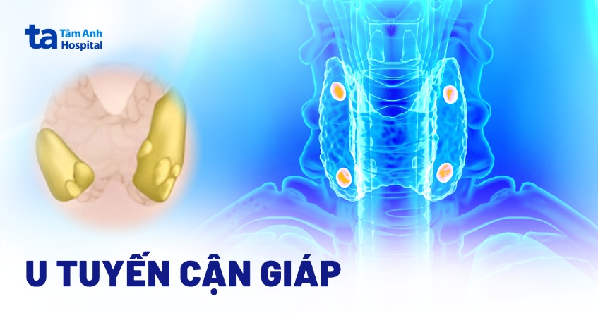 u tuyến cận giáp