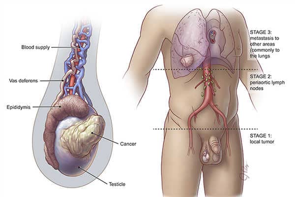 Những biến chứng khi bị kẹp màng tinh hoàn