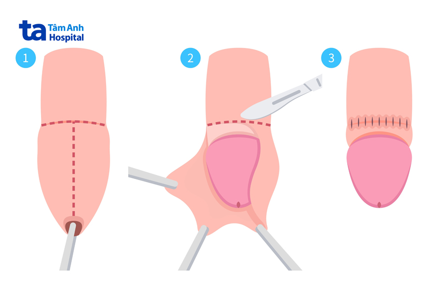 Thủ thuật cắt bao quy đầu truyền thống