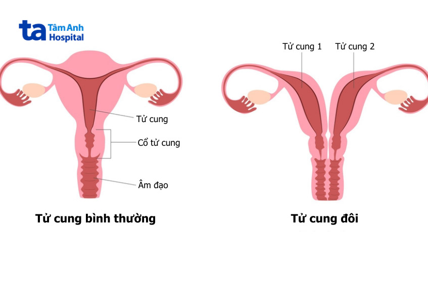 hình ảnh dị tật 2 tử cung