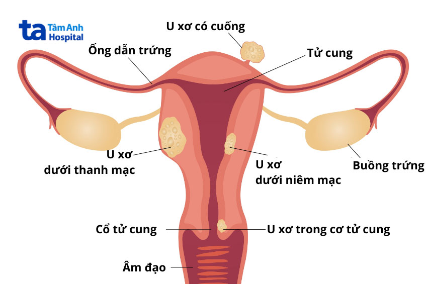 các vị trí xuất hiện nhân xơ