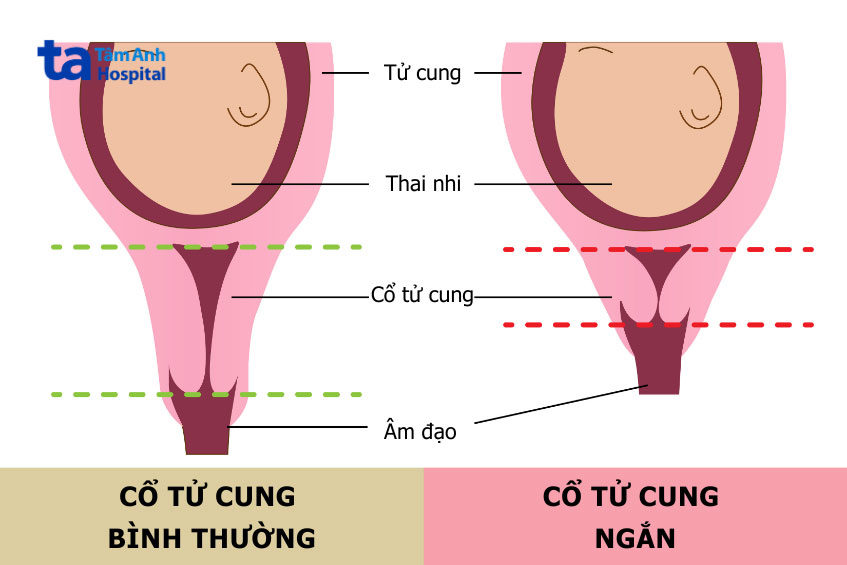 so sánh cổ tử cung bình thường và ngắn