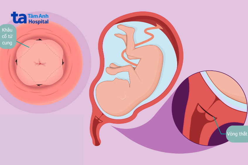 khâu vòng tử cung dự phòng chuyển dạ sớm