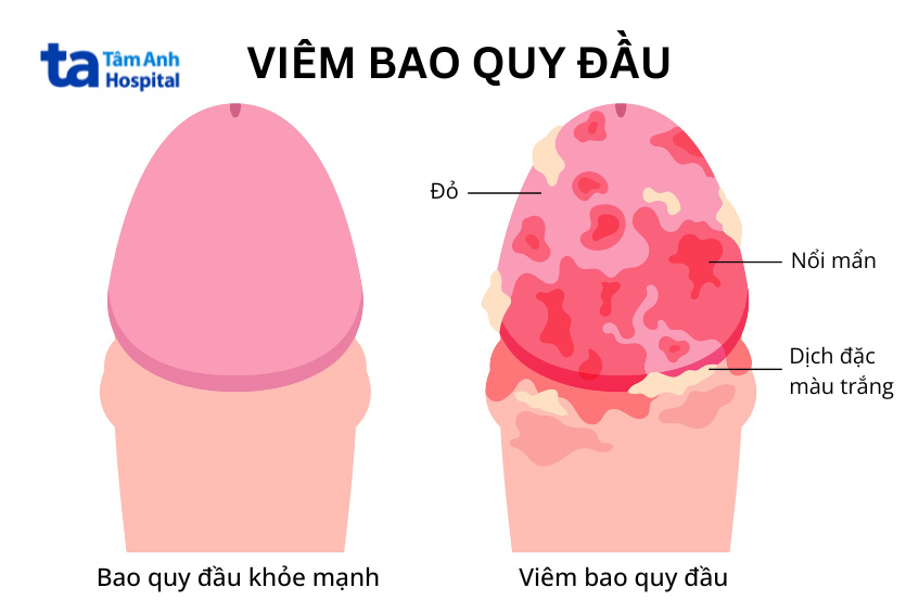 Việc vệ sinh vùng kín không đúng cách có thể làm tăng nguy cơ viêm quy đầu ở nam giới