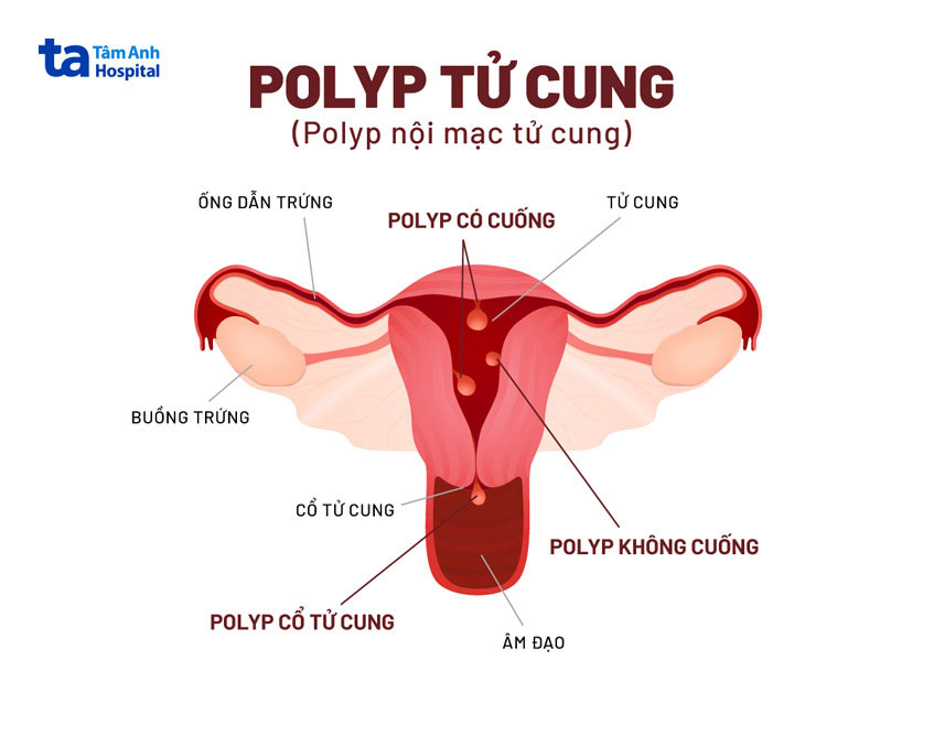 polyp là bệnh lý nội mạc tử cung phổ biến