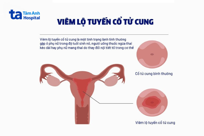 viêm lộ tuyến là bệnh lý thường gặp