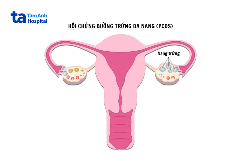 pcos là bệnh lý thường gặp ở nữ giới