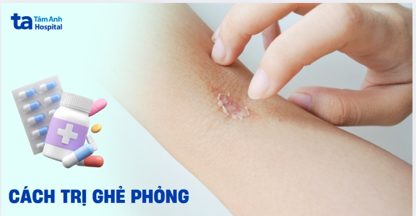 cách trị ghẻ phỏng