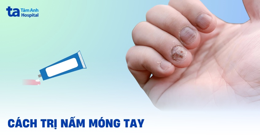 cách trị nấm móng tay