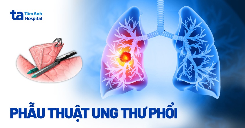 phẫu thuật ung thư phổi