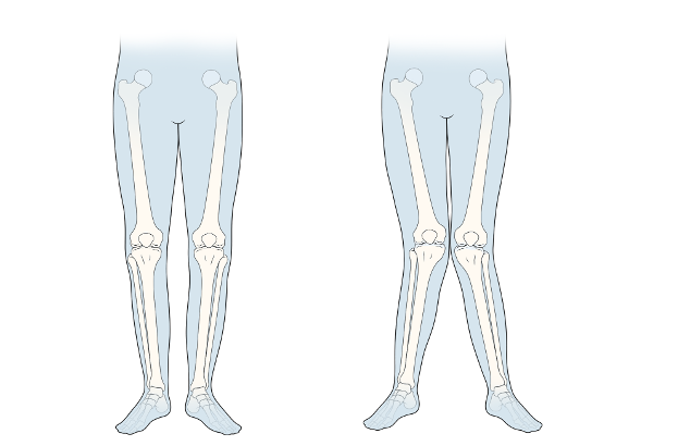 Nếu bước đi với bàn chân quá hướng vào trong hoặc hướng ra ngoài lâu dài có thể gây lệch khớp gối, khiến chân thành chữ X (phải). Ảnh: Childrenshospital