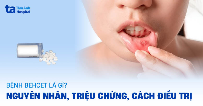 Bệnh Behcet là gì