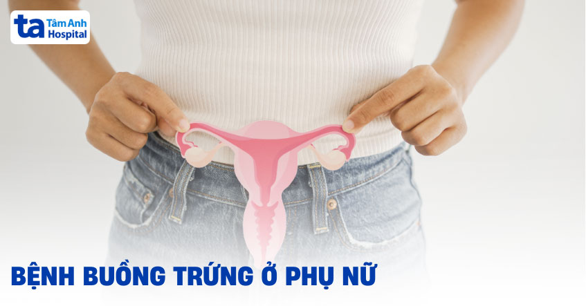 bệnh buồng trứng ở phụ nữ