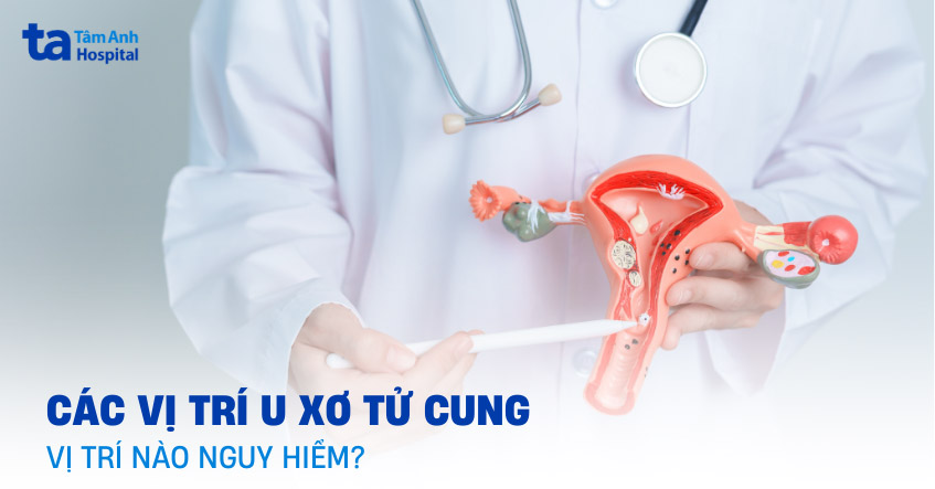 các vị trị u xơ tử cung