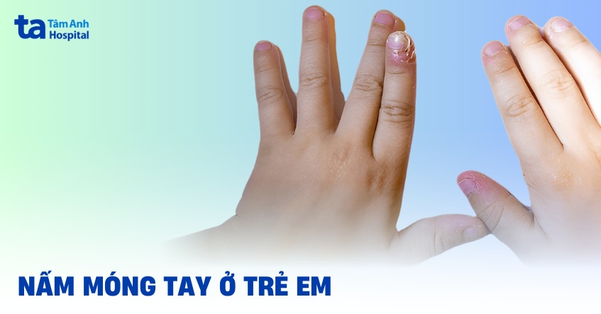 nấm móng tay ở trẻ em