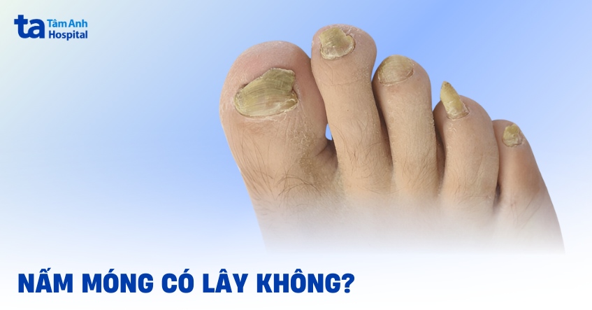 nấm móng có lây không