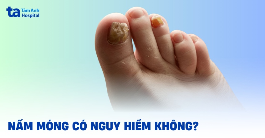 nấm móng có nguy hiểm không