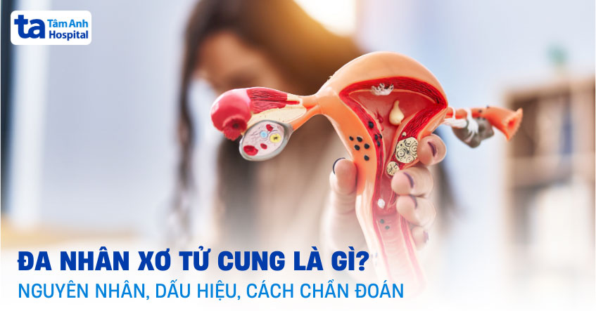 đa nhân xơ tử cung