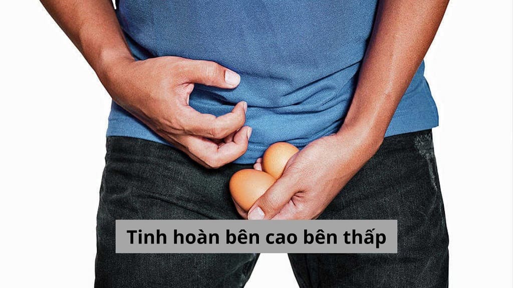 Tinh hoàn bên cao bên thấp