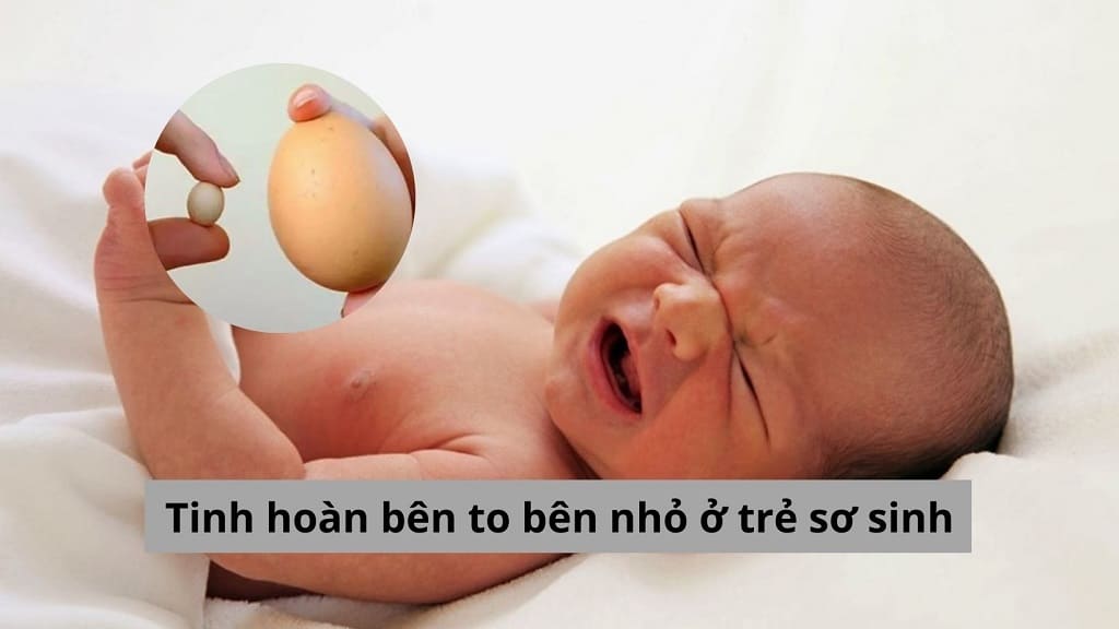 Tinh hoàn bên to bên nhỏ ở trẻ sơ sinh