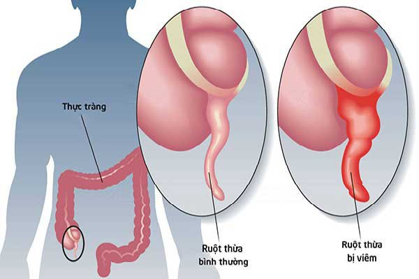 Hình ảnh so sánh ruột thừa bình thường và khi bị viêm. Ảnh: Bác sĩ cung cấp