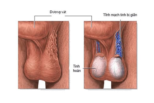 Giãn tĩnh mạch thừng tinh