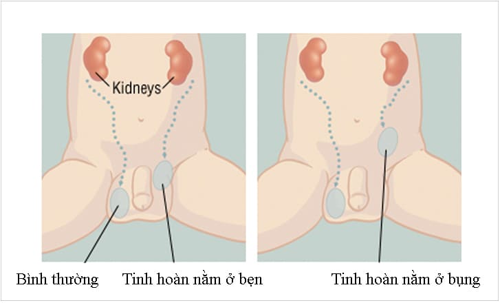 Tinh hoàn ẩn