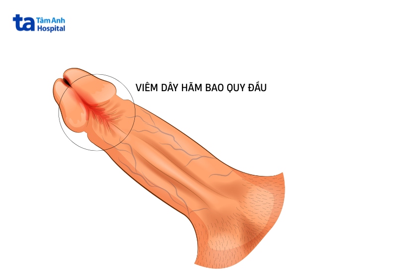 nguyên nhân dây hãm bao quy đầu ngắn