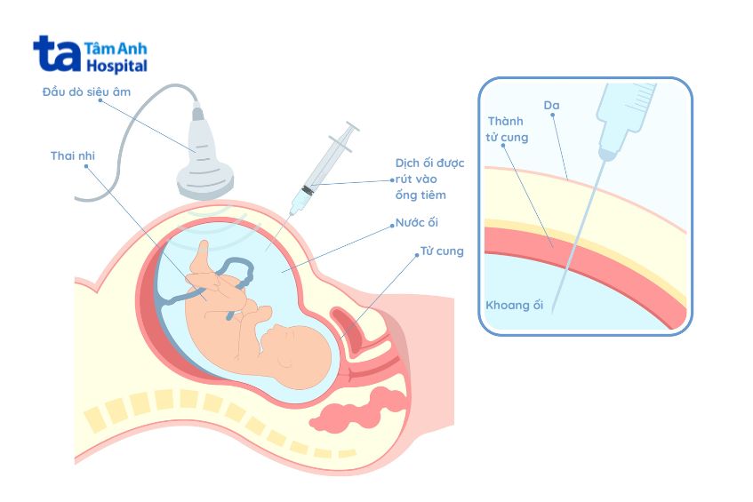 Tùy vào mức độ đa ối cũng như tình trạng thai kỳ cụ thể mà bác sĩ sẽ cân nhắc có thực hiện chọc ối điều trị đa ối hay không