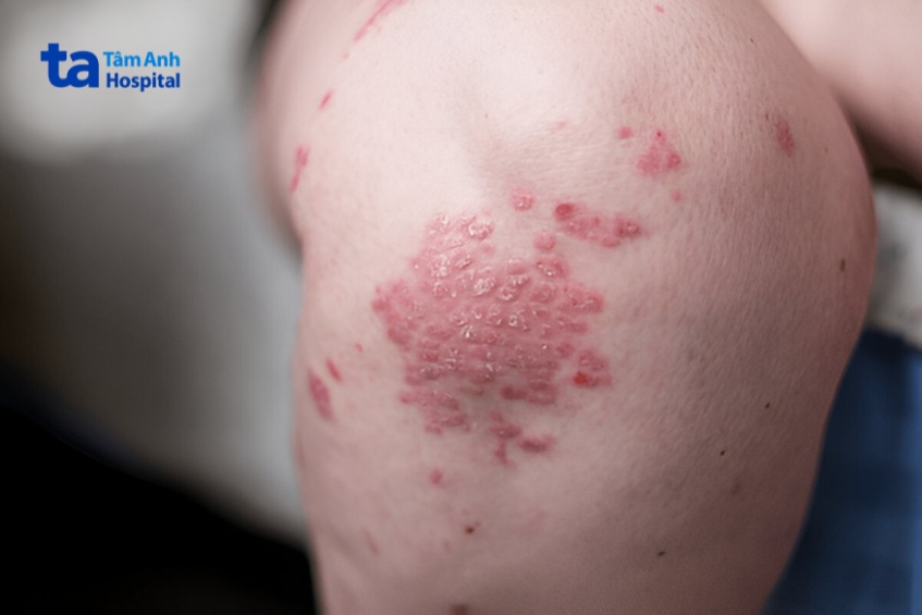 nguyên nhân ảnh hưởng sự lan rộng của vảy nến