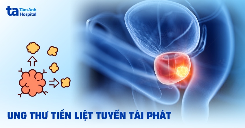 ung thư tuyến tiền liệt tái phát